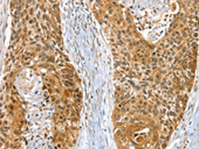 The image on the left is immunohistochemistry of paraffin-embedded Human esophagus cancer tissue using CSB-PA660209(RAB27A Antibody) at dilution 1/30, on the right is treated with fusion protein. (Original magnification: x200)