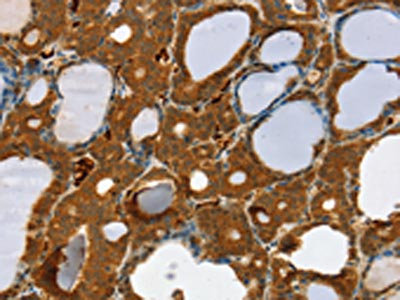 The image on the left is immunohistochemistry of paraffin-embedded Human thyroid cancer tissue using CSB-PA660209(RAB27A Antibody) at dilution 1/30, on the right is treated with fusion protein. (Original magnification: x200) The image on the left is immunohistochemistry of paraffin-embedded Human thyroid cancer tissue using CSB-PA660209(RAB27A Antibody) at dilution 1/30, on the right is treated with fusion protein. (Original magnification: x200)