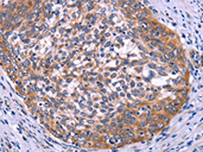 The image on the left is immunohistochemistry of paraffin-embedded Human cervical cancer tissue using CSB-PA673833(USP2 Antibody) at dilution 1/30, on the right is treated with fusion protein. (Original magnification: x200)