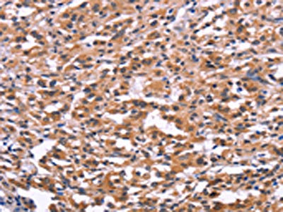 The image on the left is immunohistochemistry of paraffin-embedded Human thyroid cancer tissue using CSB-PA673833(USP2 Antibody) at dilution 1/30, on the right is treated with fusion protein. (Original magnification: x200)