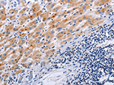 The image on the left is immunohistochemistry of paraffin-embedded Human liver cancer tissue using CSB-PA684314(SLC9A3 Antibody) at dilution 1/25, on the right is treated with synthetic peptide. (Original magnification: x200)