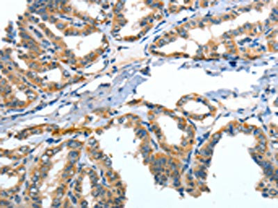 The image on the left is immunohistochemistry of paraffin-embedded Human thyroid cancer tissue using CSB-PA694467(ANGPT2 Antibody) at dilution 1/30, on the right is treated with fusion protein. (Original magnification: x200)