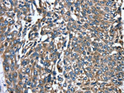 The image on the left is immunohistochemistry of paraffin-embedded Human lung cancer tissue using CSB-PA698004(PTRH2 Antibody) at dilution 1/20, on the right is treated with fusion protein. (Original magnification: x200)