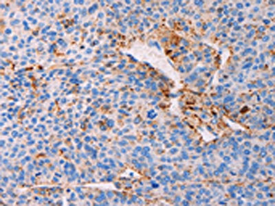 The image on the left is immunohistochemistry of paraffin-embedded Human liver cancer tissue using CSB-PA777514(PLIN2 Antibody) at dilution 1/25, on the right is treated with synthetic peptide. (Original magnification: x200)