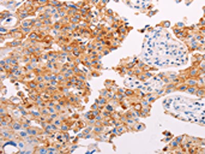 The image on the left is immunohistochemistry of paraffin-embedded Human lung cancer tissue using CSB-PA777514(PLIN2 Antibody) at dilution 1/25, on the right is treated with synthetic peptide. (Original magnification: x200) The image on the left is immunohistochemistry of paraffin-embedded Human lung cancer tissue using CSB-PA777514(PLIN2 Antibody) at dilution 1/25, on the right is treated with synthetic peptide. (Original magnification: x200)