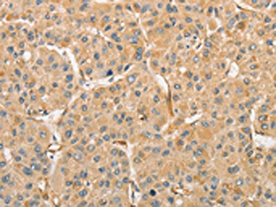 The image on the left is immunohistochemistry of paraffin-embedded Human liver cancer tissue using CSB-PA777675(ATG3 Antibody) at dilution 1/30, on the right is treated with fusion protein. (Original magnification: x200)