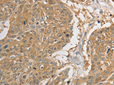 The image on the left is immunohistochemistry of paraffin-embedded Human esophagus cancer tissue using CSB-PA780249(PRDX1 Antibody) at dilution 1/20, on the right is treated with synthetic peptide. (Original magnification: x200)