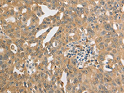 The image on the left is immunohistochemistry of paraffin-embedded Human ovarian cancer tissue using CSB-PA780249(PRDX1 Antibody) at dilution 1/20, on the right is treated with synthetic peptide. (Original magnification: x200) The image on the left is immunohistochemistry of paraffin-embedded Human ovarian cancer tissue using CSB-PA780249(PRDX1 Antibody) at dilution 1/20, on the right is treated with synthetic peptide. (Original magnification: x200)