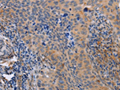 The image on the left is immunohistochemistry of paraffin-embedded Human cervical cancer tissue using CSB-PA784556(MAP3K13 Antibody) at dilution 1/40, on the right is treated with fusion protein. (Original magnification: x200)