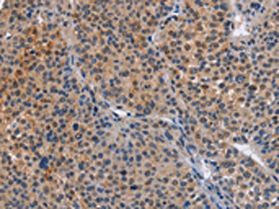 The image on the left is immunohistochemistry of paraffin-embedded Human liver cancer tissue using CSB-PA784556(MAP3K13 Antibody) at dilution 1/40, on the right is treated with fusion protein. (Original magnification: x200)