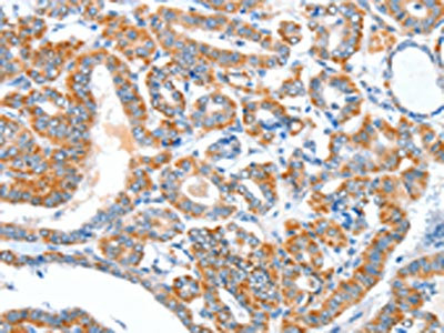 The image on the left is immunohistochemistry of paraffin-embedded Human thyroid cancer tissue using CSB-PA784753(AEBP2 Antibody) at dilution 1/25, on the right is treated with fusion protein. (Original magnification: x200)