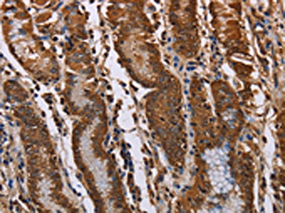 The image on the left is immunohistochemistry of paraffin-embedded Human gastric cancer tissue using CSB-PA786029(KIF2A Antibody) at dilution 1/70, on the right is treated with fusion protein. (Original magnification: x200)