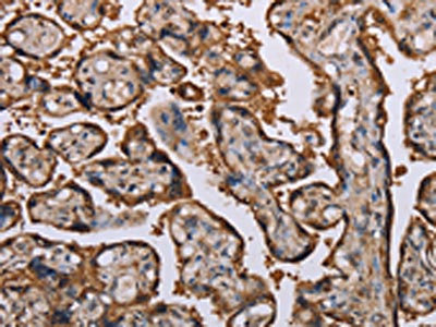 The image on the left is immunohistochemistry of paraffin-embedded Human placenta tissue using CSB-PA786029(KIF2A Antibody) at dilution 1/70, on the right is treated with fusion protein. (Original magnification: x200) The image on the left is immunohistochemistry of paraffin-embedded Human placenta tissue using CSB-PA786029(KIF2A Antibody) at dilution 1/70, on the right is treated with fusion protein. (Original magnification: x200)