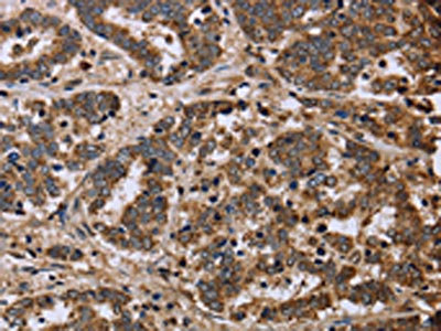 The image on the left is immunohistochemistry of paraffin-embedded Human liver cancer tissue using CSB-PA788032(FH Antibody) at dilution 1/40, on the right is treated with fusion protein. (Original magnification: x200)