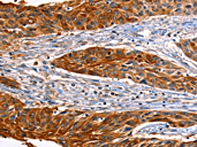 The image on the left is immunohistochemistry of paraffin-embedded Human liver cancer tissue using CSB-PA794163(ID4 Antibody) at dilution 1/20, on the right is treated with synthetic peptide. (Original magnification: x200)