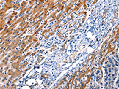 The image on the left is immunohistochemistry of paraffin-embedded Human esophagus cancer tissue using CSB-PA794163(ID4 Antibody) at dilution 1/20, on the right is treated with synthetic peptide. (Original magnification: x200)