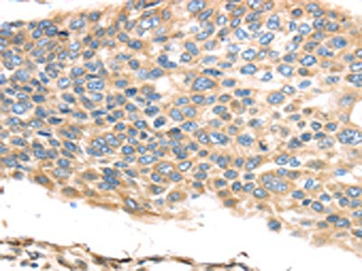 The image on the left is immunohistochemistry of paraffin-embedded Human esophagus cancer tissue using CSB-PA795013(TMED2 Antibody) at dilution 1/30, on the right is treated with fusion protein. (Original magnification: x200)