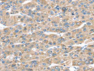 The image on the left is immunohistochemistry of paraffin-embedded Human liver cancer tissue using CSB-PA795013(TMED2 Antibody) at dilution 1/30, on the right is treated with fusion protein. (Original magnification: x200)