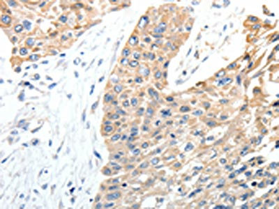 The image on the left is immunohistochemistry of paraffin-embedded Human esophagus cancer tissue using CSB-PA795802(STEAP4 Antibody) at dilution 1/40, on the right is treated with synthetic peptide. (Original magnification: x200)