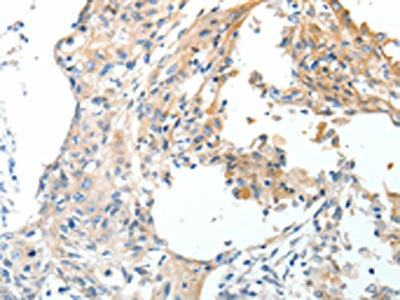 The image on the left is immunohistochemistry of paraffin-embedded Human cervical cancer tissue using CSB-PA795802(STEAP4 Antibody) at dilution 1/40, on the right is treated with synthetic peptide. (Original magnification: x200) The image on the left is immunohistochemistry of paraffin-embedded Human cervical cancer tissue using CSB-PA795802(STEAP4 Antibody) at dilution 1/40, on the right is treated with synthetic peptide. (Original magnification: x200)