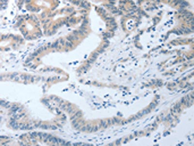 The image on the left is immunohistochemistry of paraffin-embedded Human colon cancer tissue using CSB-PA808676(LOX Antibody) at dilution 1/25, on the right is treated with synthetic peptide. (Original magnification: x200)
