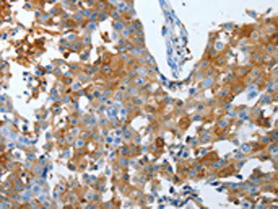 The image on the left is immunohistochemistry of paraffin-embedded Human breast cancer tissue using CSB-PA808676(LOX Antibody) at dilution 1/25, on the right is treated with synthetic peptide. (Original magnification: x200)