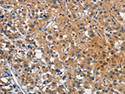 The image on the left is immunohistochemistry of paraffin-embedded Human thyroid cancer tissue using CSB-PA815431(CEACAM1 Antibody) at dilution 1/25, on the right is treated with synthetic peptide. (Original magnification: x200)