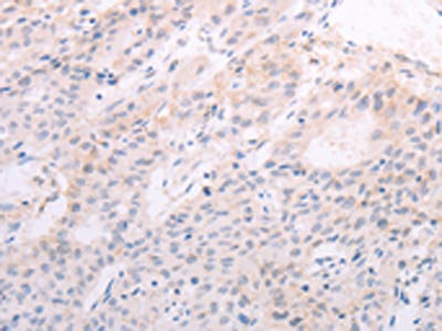 The image on the left is immunohistochemistry of paraffin-embedded Human liver cancer tissue using CSB-PA820027(TSHR Antibody) at dilution 1/50, on the right is treated with fusion protein. (Original magnification: x200) The image on the left is immunohistochemistry of paraffin-embedded Human liver cancer tissue using CSB-PA820027(TSHR Antibody) at dilution 1/50, on the right is treated with fusion protein. (Original magnification: x200)