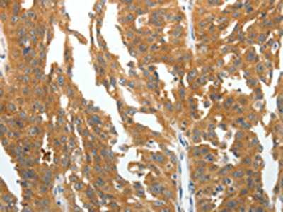 The image on the left is immunohistochemistry of paraffin-embedded Human ovarian cancer tissue using CSB-PA826561(RGS2 Antibody) at dilution 1/40, on the right is treated with fusion protein. (Original magnification: x200)