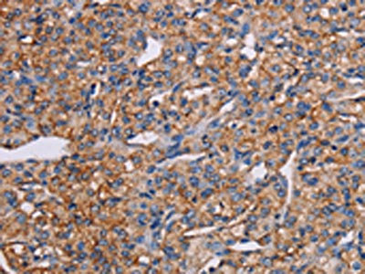 The image on the left is immunohistochemistry of paraffin-embedded Human prostate cancer tissue using CSB-PA831601(GHITM Antibody) at dilution 1/30, on the right is treated with fusion protein. (Original magnification: x200)
