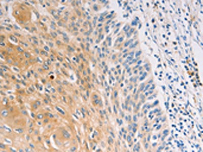 The image on the left is immunohistochemistry of paraffin-embedded Human breast cancer tissue using CSB-PA831664(MUC5B Antibody) at dilution 1/30, on the right is treated with synthetic peptide. (Original magnification: x200) The image on the left is immunohistochemistry of paraffin-embedded Human breast cancer tissue using CSB-PA831664(MUC5B Antibody) at dilution 1/30, on the right is treated with synthetic peptide. (Original magnification: x200)
