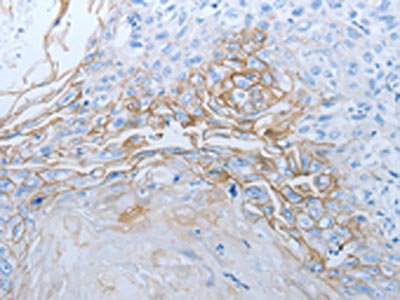 The image on the left is immunohistochemistry of paraffin-embedded Human esophagus cancer tissue using CSB-PA843591(JUP Antibody) at dilution 1/20, on the right is treated with synthetic peptide. (Original magnification: x200)