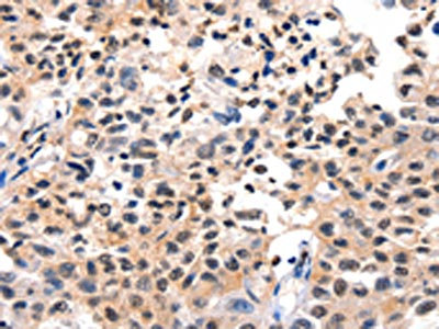 The image on the left is immunohistochemistry of paraffin-embedded Human lung cancer tissue using CSB-PA845102(FOXB2 Antibody) at dilution 1/5, on the right is treated with synthetic peptide. (Original magnification: x200)