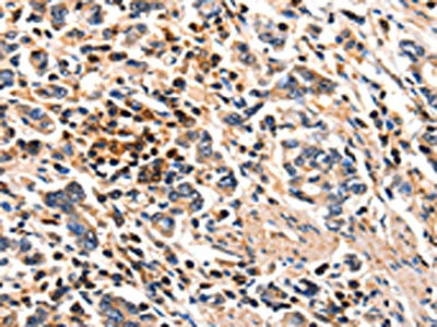 The image on the left is immunohistochemistry of paraffin-embedded Human gastic cancer tissue using CSB-PA845102(FOXB2 Antibody) at dilution 1/5, on the right is treated with synthetic peptide. (Original magnification: x200) The image on the left is immunohistochemistry of paraffin-embedded Human gastic cancer tissue using CSB-PA845102(FOXB2 Antibody) at dilution 1/5, on the right is treated with synthetic peptide. (Original magnification: x200)