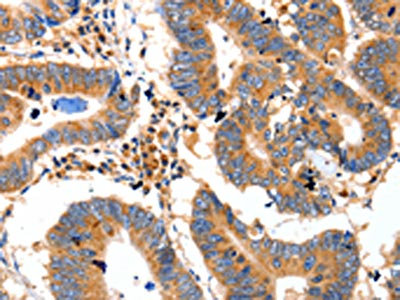 The image on the left is immunohistochemistry of paraffin-embedded Human colon cancer tissue using CSB-PA869336(IDE Antibody) at dilution 1/20, on the right is treated with fusion protein. (Original magnification: x200)