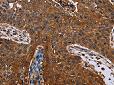 The image on the left is immunohistochemistry of paraffin-embedded Human lung cancer tissue using CSB-PA869662(JUP Antibody) at dilution 1/40, on the right is treated with fusion protein. (Original magnification: x200)