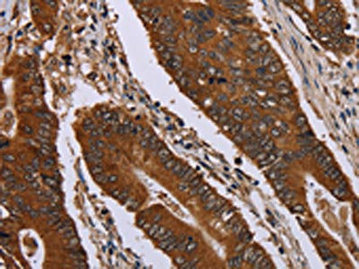 The image on the left is immunohistochemistry of paraffin-embedded Human colon cancer tissue using CSB-PA869662(JUP Antibody) at dilution 1/40, on the right is treated with fusion protein. (Original magnification: x200)