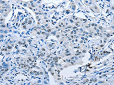 The image on the left is immunohistochemistry of paraffin-embedded Human lung cancer tissue using CSB-PA889734(ARHGEF2 Antibody) at dilution 1/30, on the right is treated with fusion protein. (Original magnification: x200)