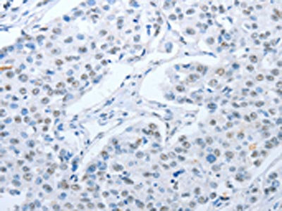 The image on the left is immunohistochemistry of paraffin-embedded Human breast cancer tissue using CSB-PA889734(ARHGEF2 Antibody) at dilution 1/30, on the right is treated with fusion protein. (Original magnification: x200) The image on the left is immunohistochemistry of paraffin-embedded Human breast cancer tissue using CSB-PA889734(ARHGEF2 Antibody) at dilution 1/30, on the right is treated with fusion protein. (Original magnification: x200)