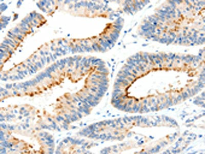 The image on the left is immunohistochemistry of paraffin-embedded Human colon cancer tissue using CSB-PA900670(MAP4K1 Antibody) at dilution 1/30, on the right is treated with synthetic peptide. (Original magnification: x200)