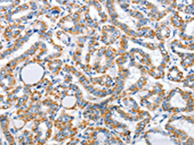 The image on the left is immunohistochemistry of paraffin-embedded Human thyroid cancer tissue using CSB-PA902603(ARL11 Antibody) at dilution 1/30, on the right is treated with fusion protein. (Original magnification: x200) The image on the left is immunohistochemistry of paraffin-embedded Human thyroid cancer tissue using CSB-PA902603(ARL11 Antibody) at dilution 1/30, on the right is treated with fusion protein. (Original magnification: x200)