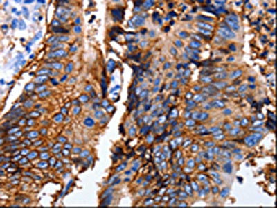 The image on the left is immunohistochemistry of paraffin-embedded Human colon cancer tissue using CSB-PA902732(EPCAM Antibody) at dilution 1/25, on the right is treated with synthetic peptide. (Original magnification: x200) The image on the left is immunohistochemistry of paraffin-embedded Human colon cancer tissue using CSB-PA902732(EPCAM Antibody) at dilution 1/25, on the right is treated with synthetic peptide. (Original magnification: x200)