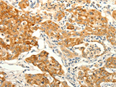 The image on the left is immunohistochemistry of paraffin-embedded Human lung cancer tissue using CSB-PA903141(ERG Antibody) at dilution 1/30, on the right is treated with fusion protein. (Original magnification: x200)