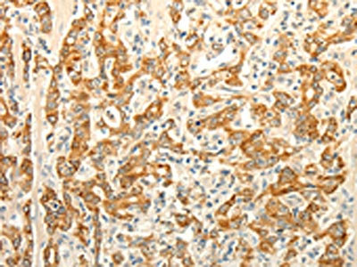 The image on the left is immunohistochemistry of paraffin-embedded Human gastic cancer tissue using CSB-PA903141(ERG Antibody) at dilution 1/30, on the right is treated with fusion protein. (Original magnification: x200)