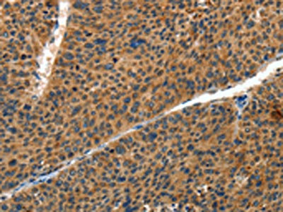 The image on the left is immunohistochemistry of paraffin-embedded Human liver cancer tissue using CSB-PA903370(IL22RA1 Antibody) at dilution 1/20, on the right is treated with fusion protein. (Original magnification: x200)