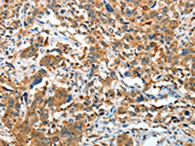 The image on the left is immunohistochemistry of paraffin-embedded Human esophagus cancer tissue using CSB-PA903370(IL22RA1 Antibody) at dilution 1/20, on the right is treated with fusion protein. (Original magnification: x200)
