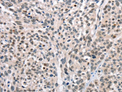 The image on the left is immunohistochemistry of paraffin-embedded Human esophagus cancer tissue using CSB-PA904720(CABLES1 Antibody) at dilution 1/15, on the right is treated with fusion protein. (Original magnification: x200)