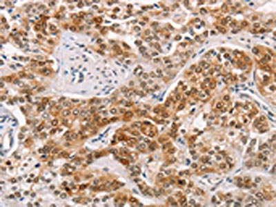 The image on the left is immunohistochemistry of paraffin-embedded Human prostate cancer tissue using CSB-PA904720(CABLES1 Antibody) at dilution 1/15, on the right is treated with fusion protein. (Original magnification: x200) The image on the left is immunohistochemistry of paraffin-embedded Human prostate cancer tissue using CSB-PA904720(CABLES1 Antibody) at dilution 1/15, on the right is treated with fusion protein. (Original magnification: x200)
