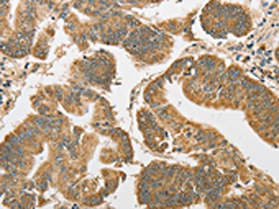The image on the left is immunohistochemistry of paraffin-embedded Human colon cancer tissue using CSB-PA914063(ATG3 Antibody) at dilution 1/40, on the right is treated with fusion protein. (Original magnification: x200)