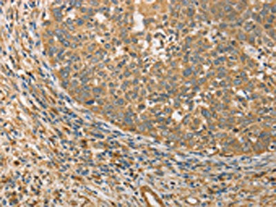 The image on the left is immunohistochemistry of paraffin-embedded Human cervical cancer tissue using CSB-PA914063(ATG3 Antibody) at dilution 1/40, on the right is treated with fusion protein. (Original magnification: x200)